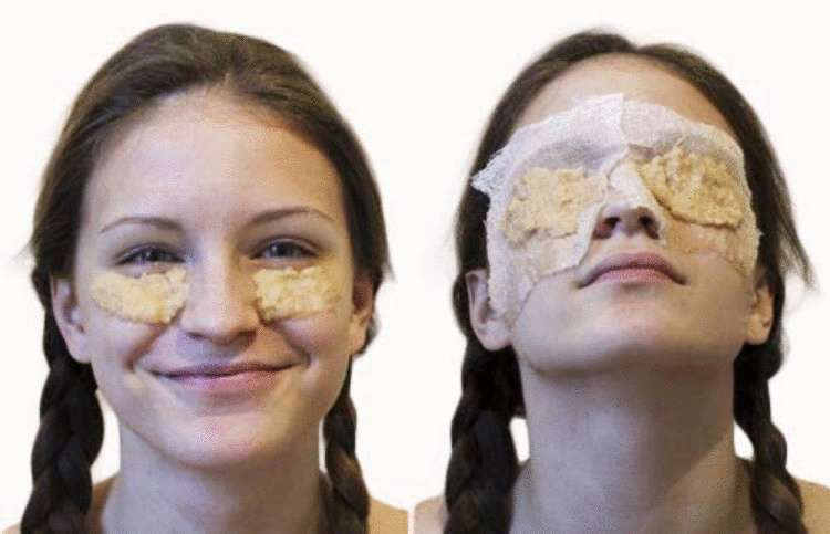 Как убрать синяки под глазами без использования химии