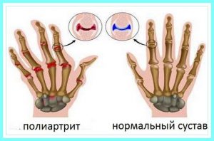 Причины онемения рук