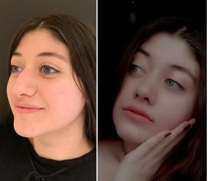 Czy wiesz, czym jest plastyka nosa?