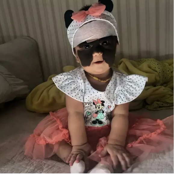 „Batgirl dorosła!” Spójrz na Lunę Ferrer, która urodziła się „zamaskowana”. Tak wygląda teraz, gdy przeszła operację
