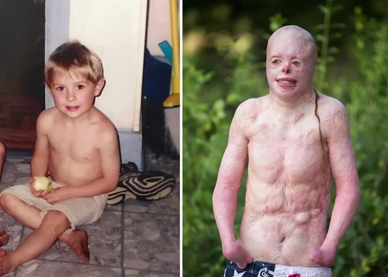 Następstwa wypadku. Jak wyglądał Johnny Quinn przed pożarem?