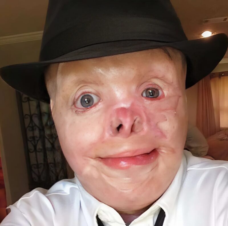Następstwa wypadku. Jak wyglądał Johnny Quinn przed pożarem?