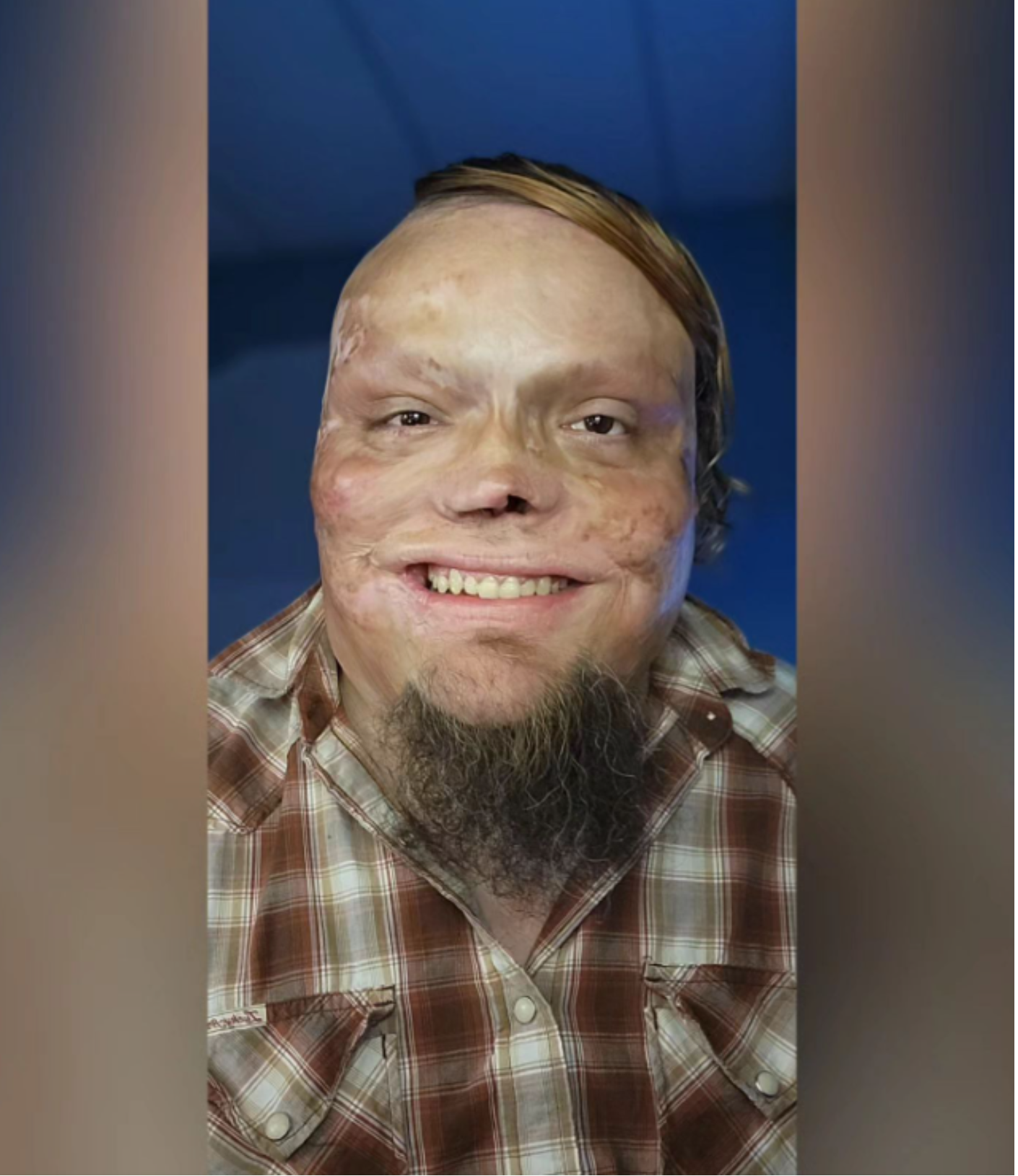 On i dzieci zostali porzuceni przez żonę. W dzieciństwie został ranny i 98% jego ciała jest poparzone. Jak teraz żyje samotny ojciec