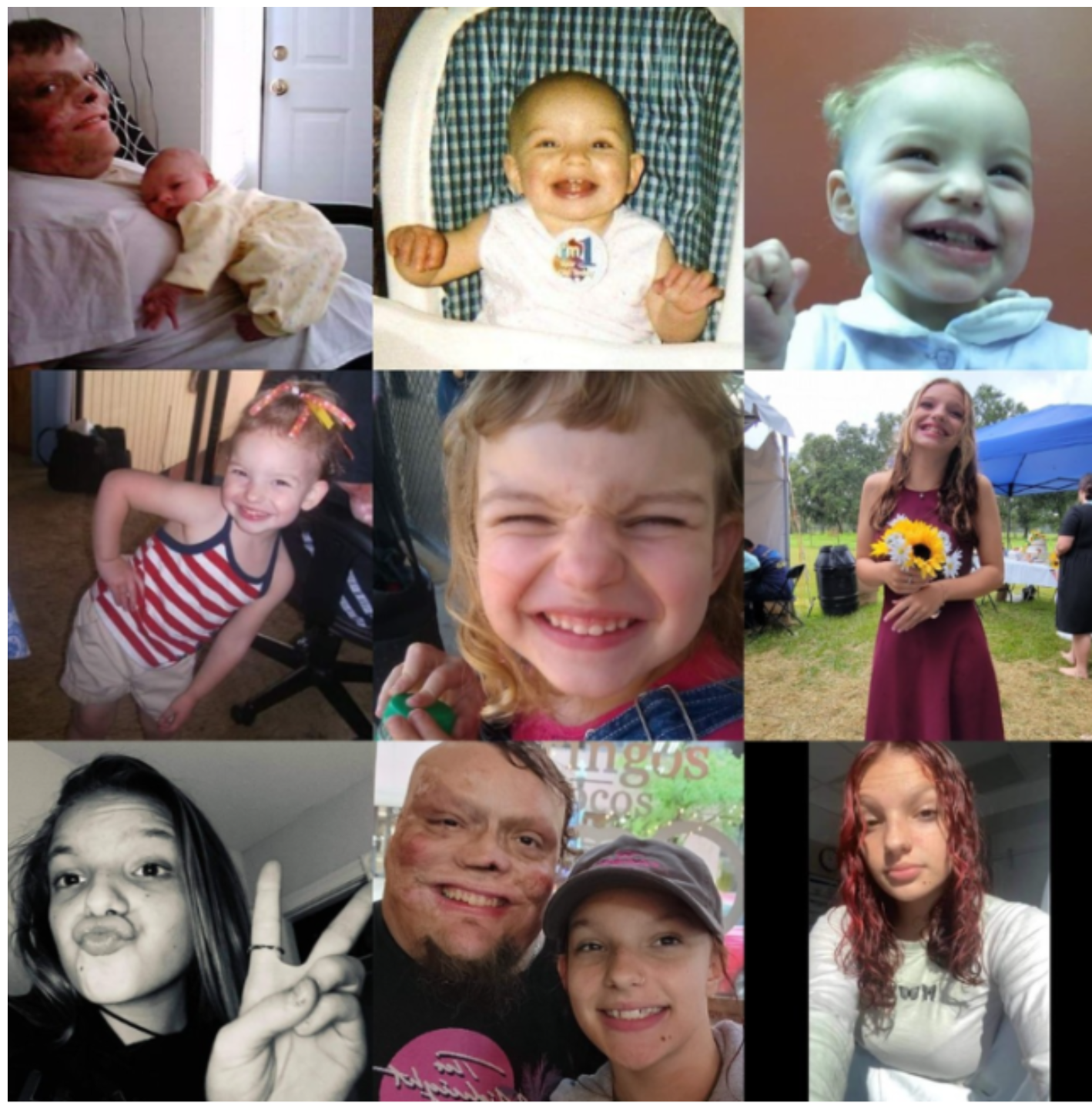 On i dzieci zostali porzuceni przez żonę. W dzieciństwie został ranny i 98% jego ciała jest poparzone. Jak teraz żyje samotny ojciec