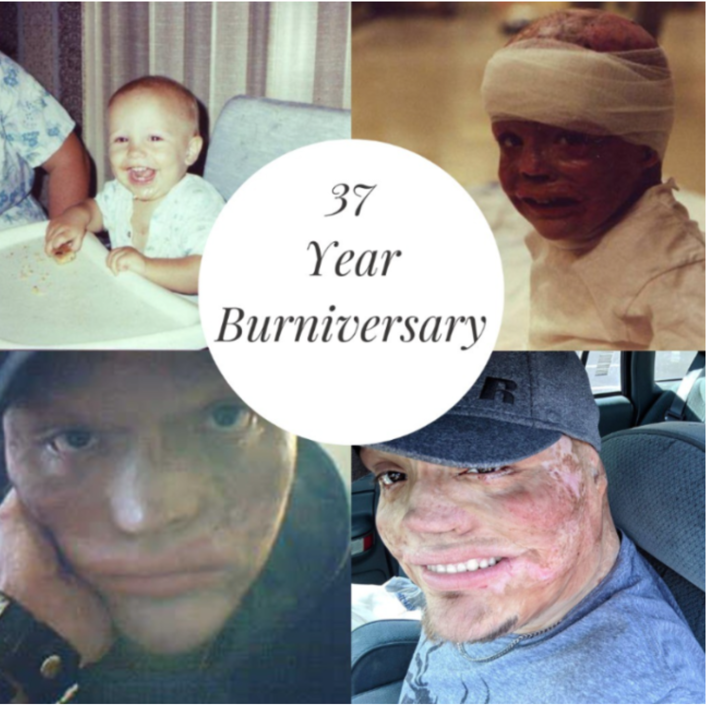 On i dzieci zostali porzuceni przez żonę. W dzieciństwie został ranny i 98% jego ciała jest poparzone. Jak teraz żyje samotny ojciec