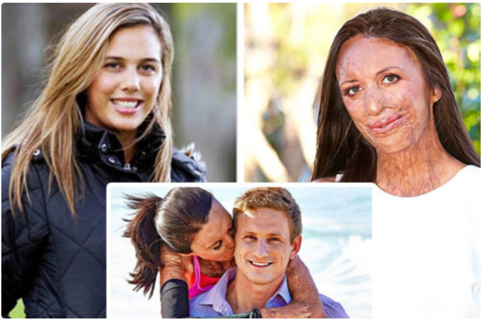 Dwieście operacji, które przywróciły ją do życia. Niesamowita historia australijskiej modelki, która padła ofiarą pożaru.