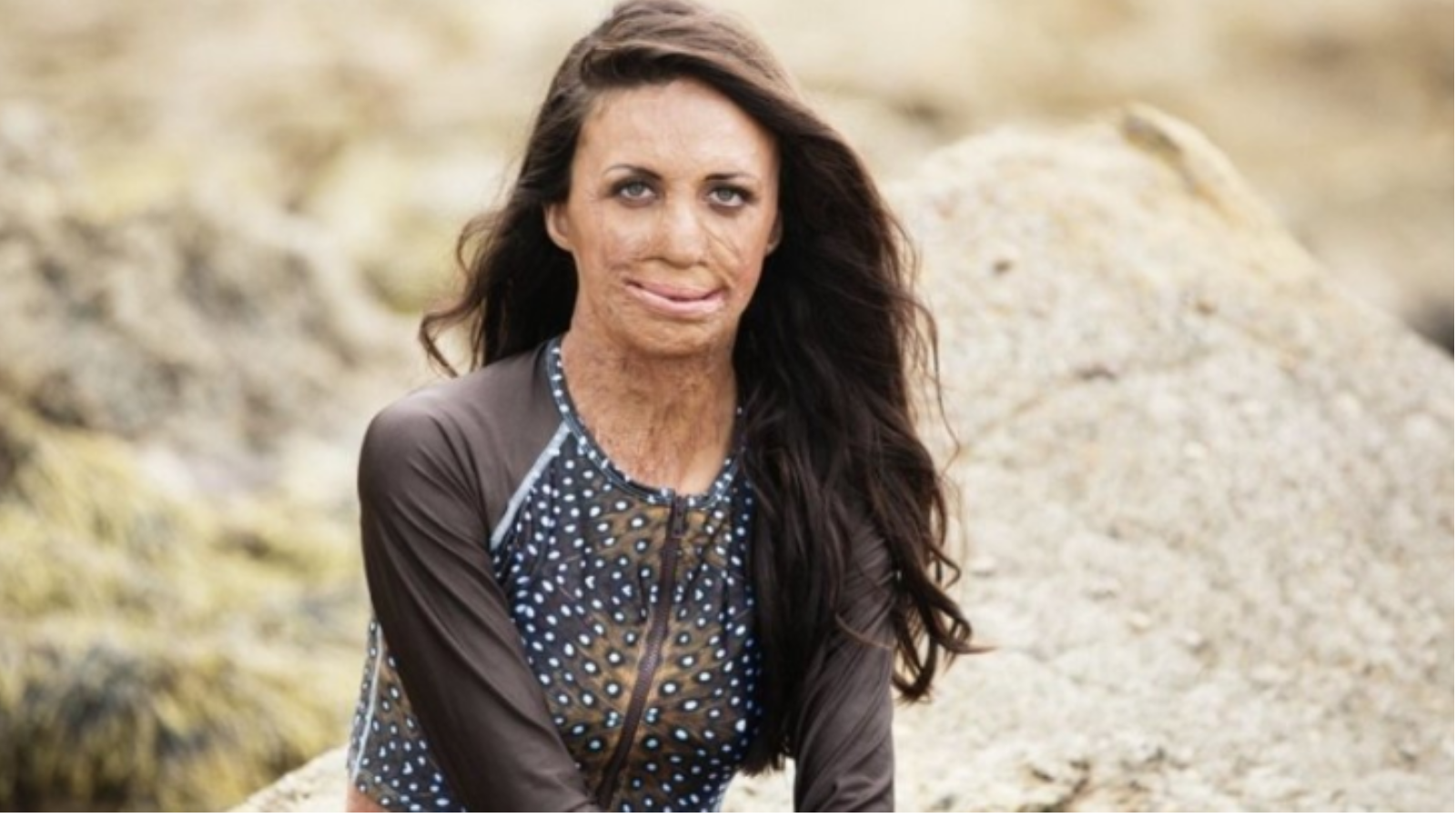 Dwieście operacji, które przywróciły ją do życia. Niesamowita historia australijskiej modelki, która padła ofiarą pożaru.