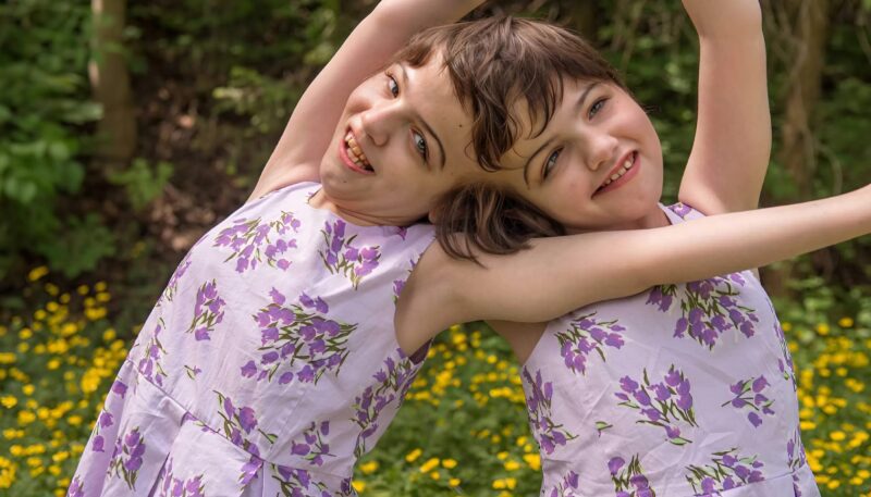 Siostry miały zrośnięte głowy, ale mimo to udało im się dożyć pełnoletności.