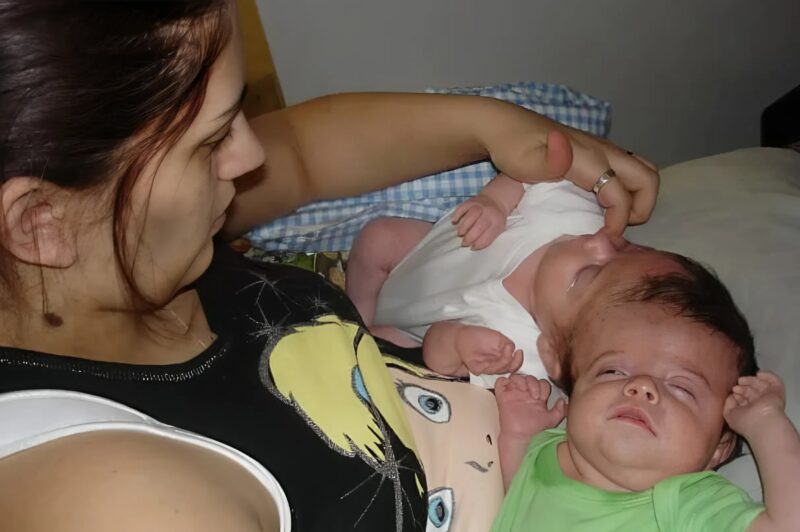 Siostry miały zrośnięte głowy, ale mimo to udało im się dożyć pełnoletności.