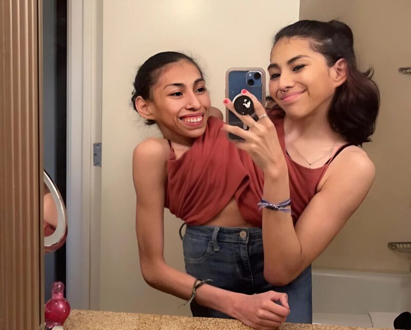 Te syjamskie bliźniaczki były zrośnięte w okolicy brzucha, ale znalazły swoje szczęście i wyszły za mąż za jednego faceta. Oto jak wygląda.