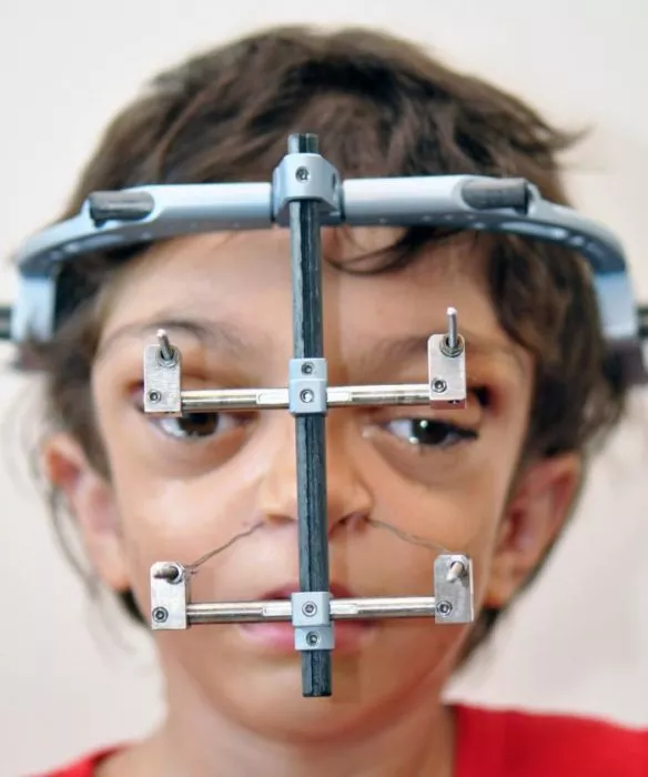 Lekarze zdołali naprawić twarz tego chłopca. Spójrzcie tylko, jak wygląda dzisiaj.