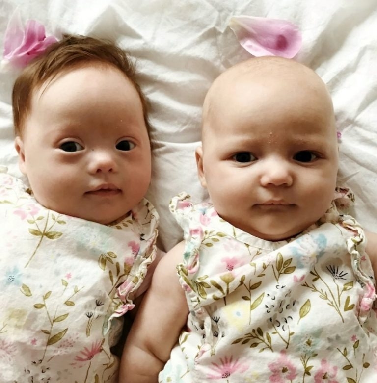 Bliźniaczki z prawdopodobieństwem jeden do miliona: jedna ma zespół Downa, druga nie!