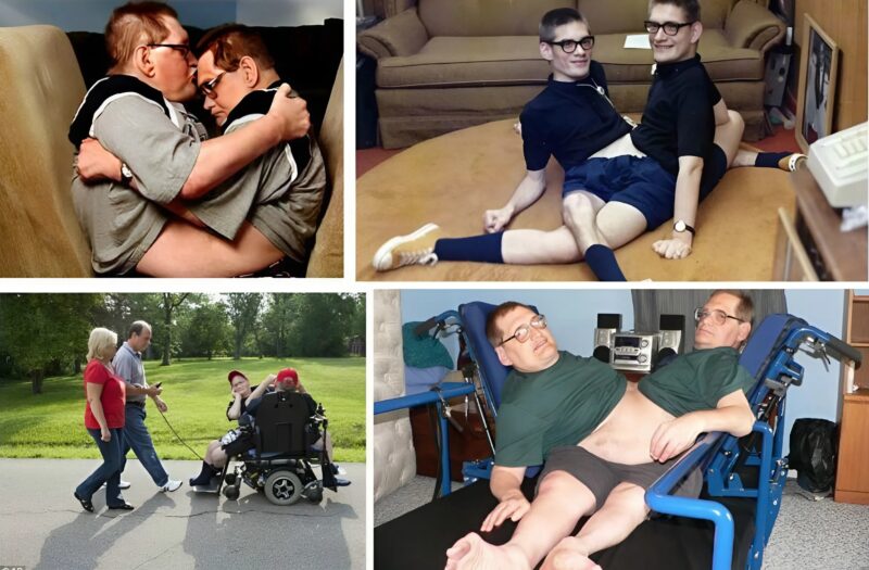 Ci bliźniacy urodzili się zrośnięci w okolicy brzucha i miednicy.