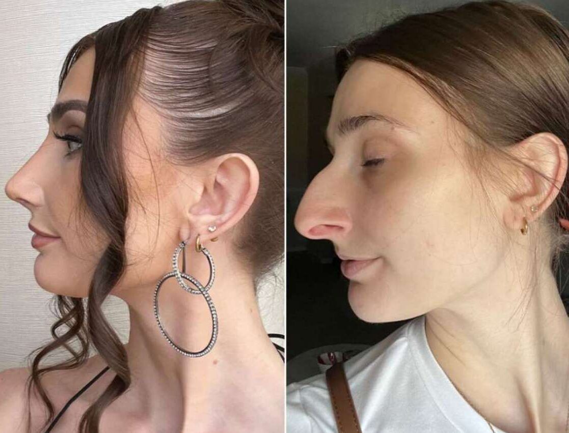 Przez 10 lat oszczędzał, aby poddać się operacji nosa – wynik zszokował wszystkich.