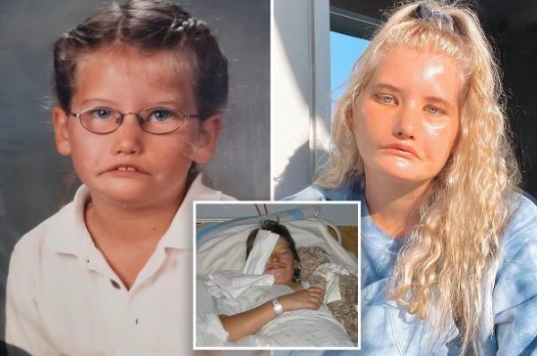 „Księżniczka bez uśmiechu”: Jak dziewczyna z tym syndromem żyje, nigdy się nie uśmiechając – Jak wygląda teraz?