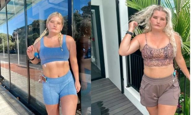 „Księżniczka bez uśmiechu”: Jak dziewczyna z tym syndromem żyje, nigdy się nie uśmiechając – Jak wygląda teraz?