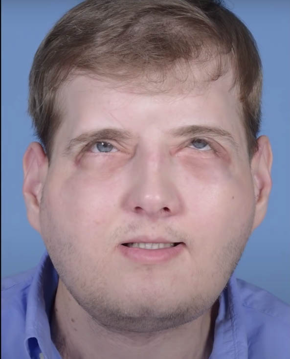 Strażak doznał oparzeń trzeciego stopnia – oto on 7 lat później