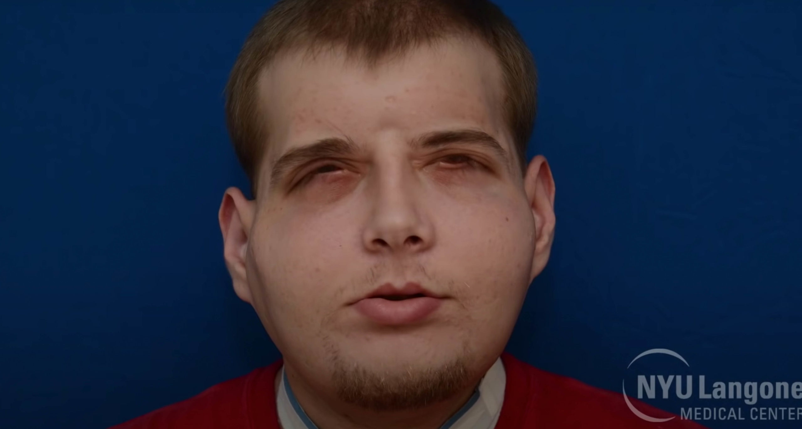 Strażak doznał oparzeń trzeciego stopnia – oto on 7 lat później