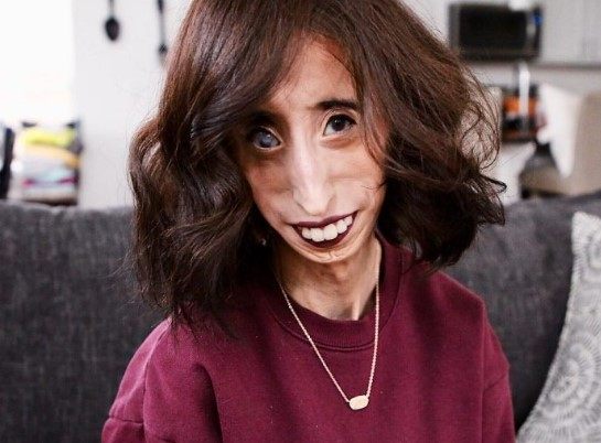 „Kobieta o okrutnym losie”: jak wygląda dziś dziewczyna, którą nazywano „najbrzydszą na świecie”?