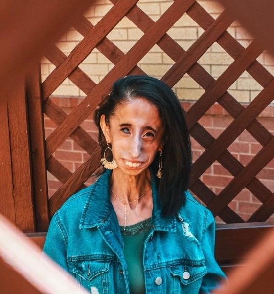 „Kobieta o okrutnym losie”: jak wygląda dziś dziewczyna, którą nazywano „najbrzydszą na świecie”?