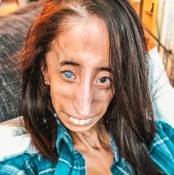 „Kobieta o okrutnym losie”: jak wygląda dziś dziewczyna, którą nazywano „najbrzydszą na świecie”?