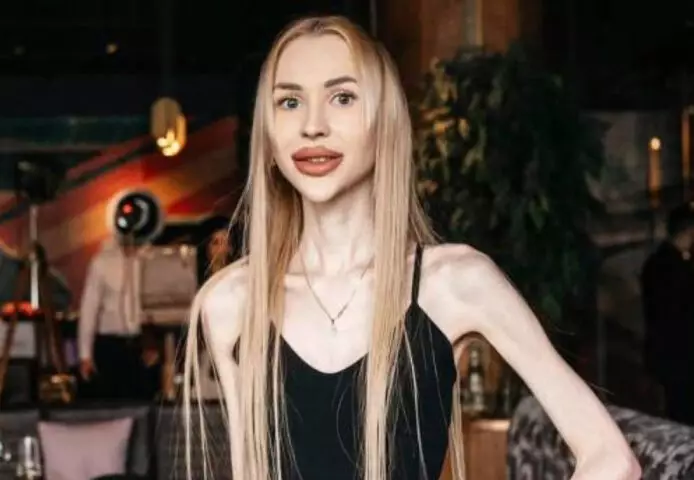 Łzy same napływają do oczu: Ukrainka ważąca 23 kilogramy pokazała, jak wyglądała przed gwałtowną utratą wagi